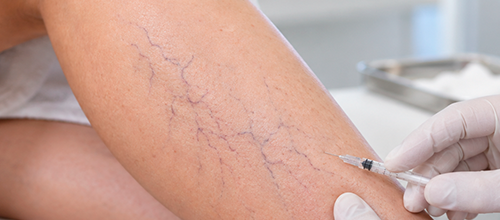 Escleroterapia